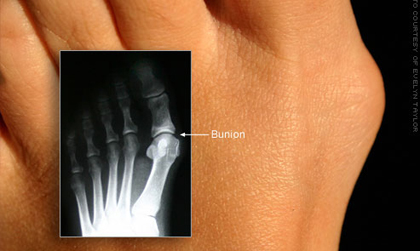 Bütyök és annak röntgen képe