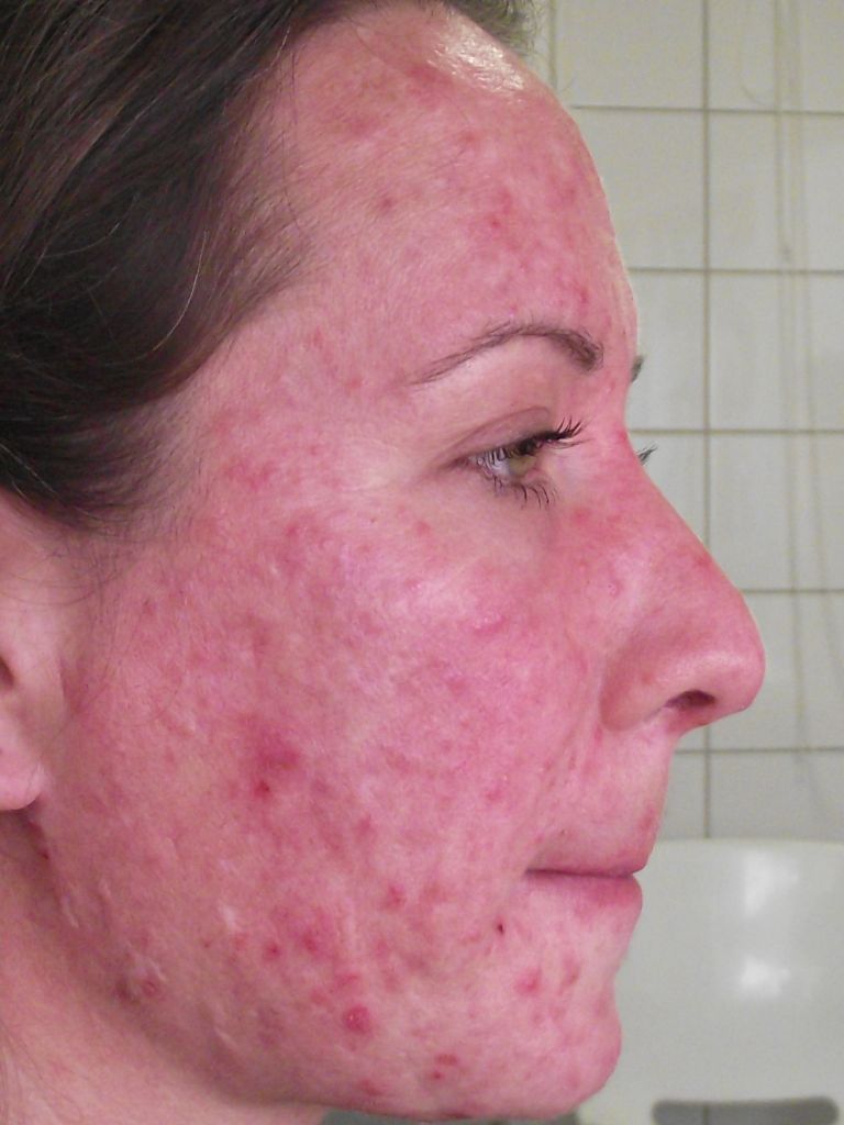 Acnes arcbőr kezelése PRP - Drakula terápia-val