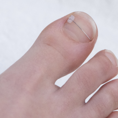 Malyshev gomba lábak és a körmöket - a megfelelő kezelés