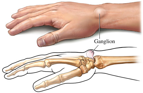 carpal ganglion kezelés)