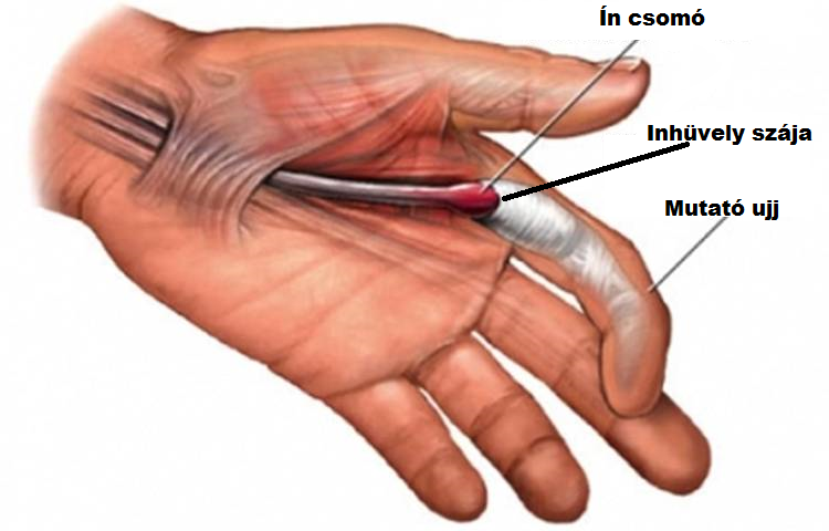 pattanó ujj kezelése boka ízületi gyulladás kezelésére szolgáló módszerek