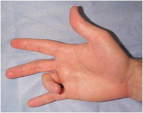 A pattanó ujj nehezíti az ujjak mozgását